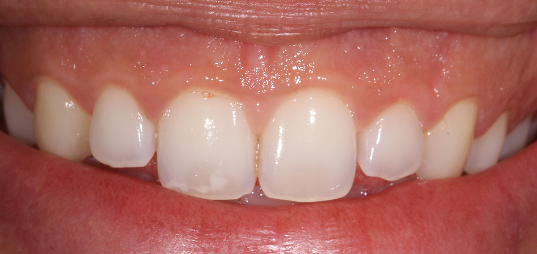 Crown Lengthening Periodontology