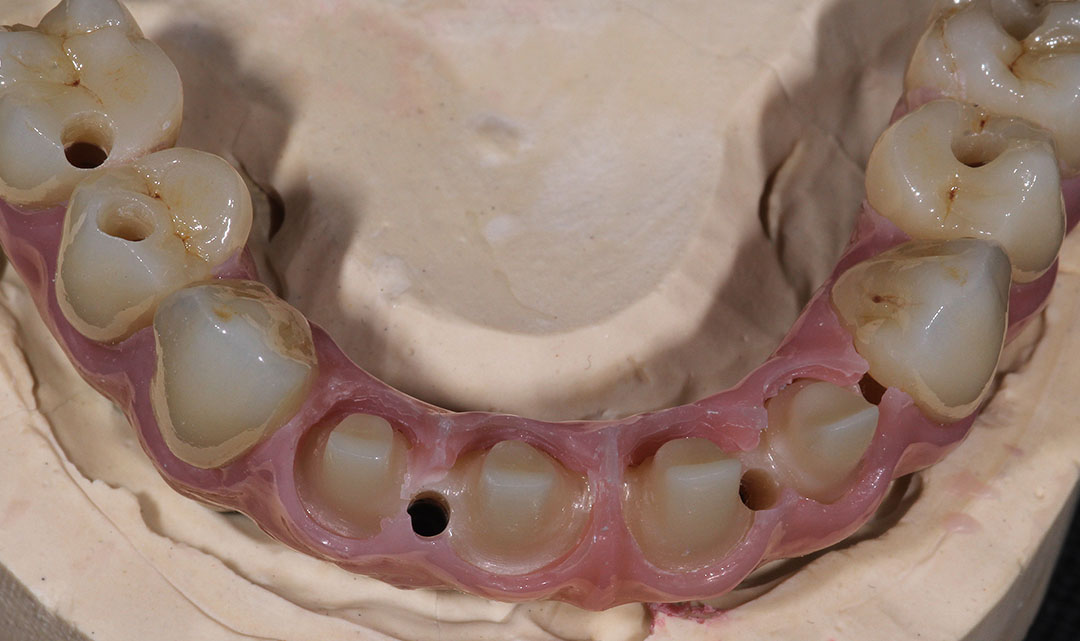 Implant Bridge Screw Retained Hybrid