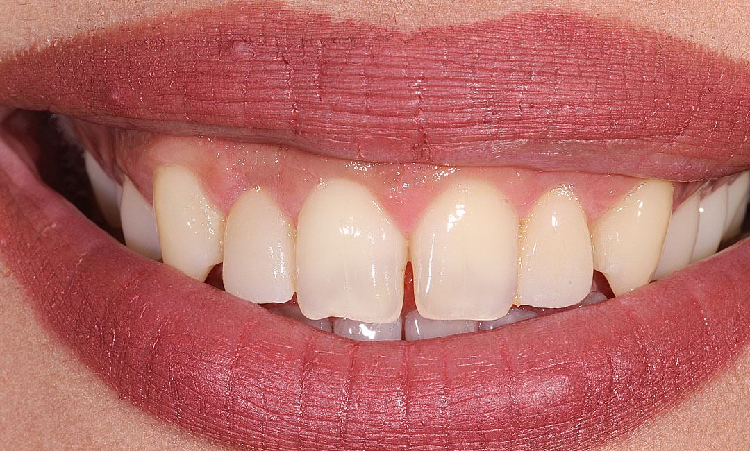 Crowns with Crown Lengthening