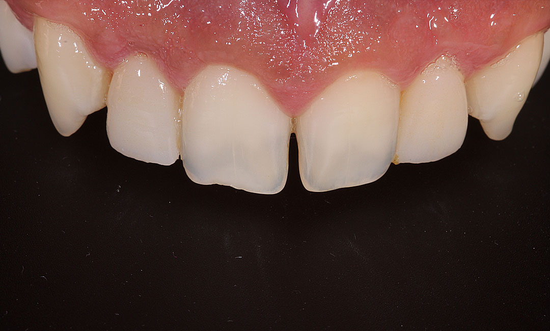 Crowns with Crown Lengthening